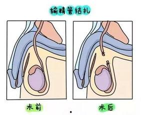 女人结扎手术图片,术前术后注意事项一览